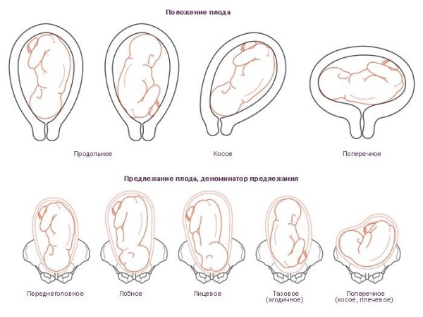 Виды тазовых предлежаний и биомеханизм родов, упражения для переворота плода