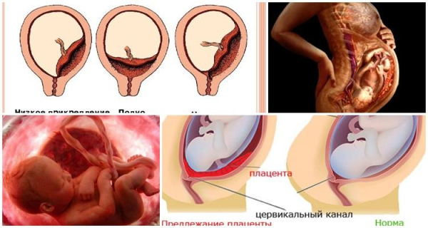 Виды и симптомы предлежания плаценты, чем опасно и меры профилактики