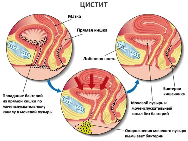 Может ли быть цистит первым признаком беременности и лечение на разных сроках